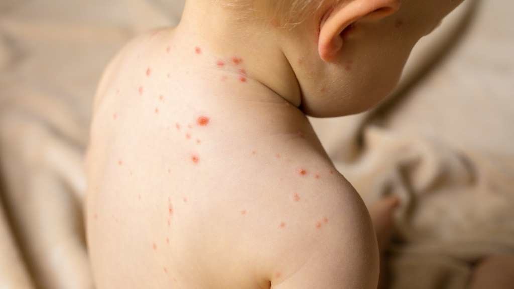 A varíola do mono é máis frecuente en crianzas. (Foto: Kaspars Grinvalds)