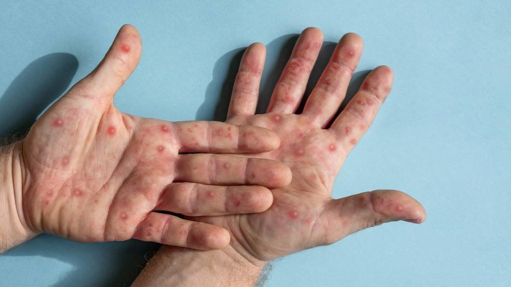 Unha persoa con síntomas da varíola dos macacos. (Foto: Marina Demidiuk)