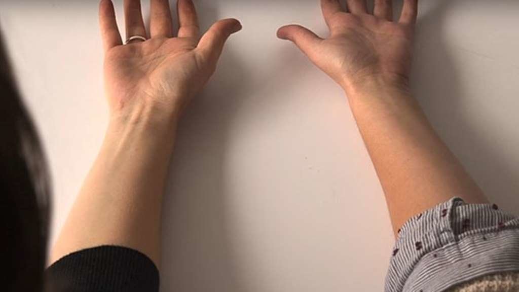 Á esquerda, un brazo co palmar longo; á dereita, outro que carece deste músculo. (Foto: Emol)