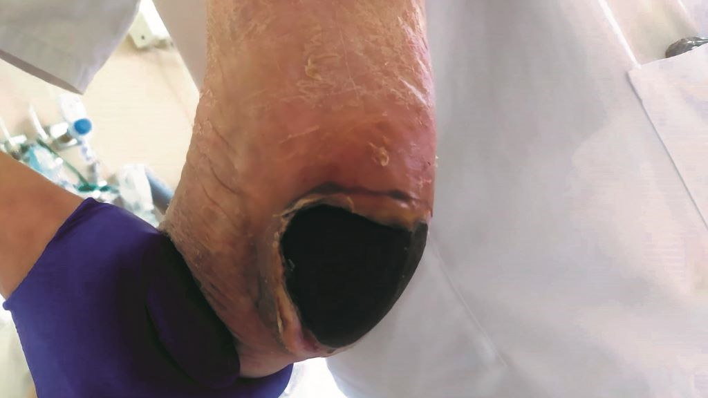 Úlcera no talón dunha residente de DomusVi de Monforte de Lemos. (Foto: Asociación Rede)