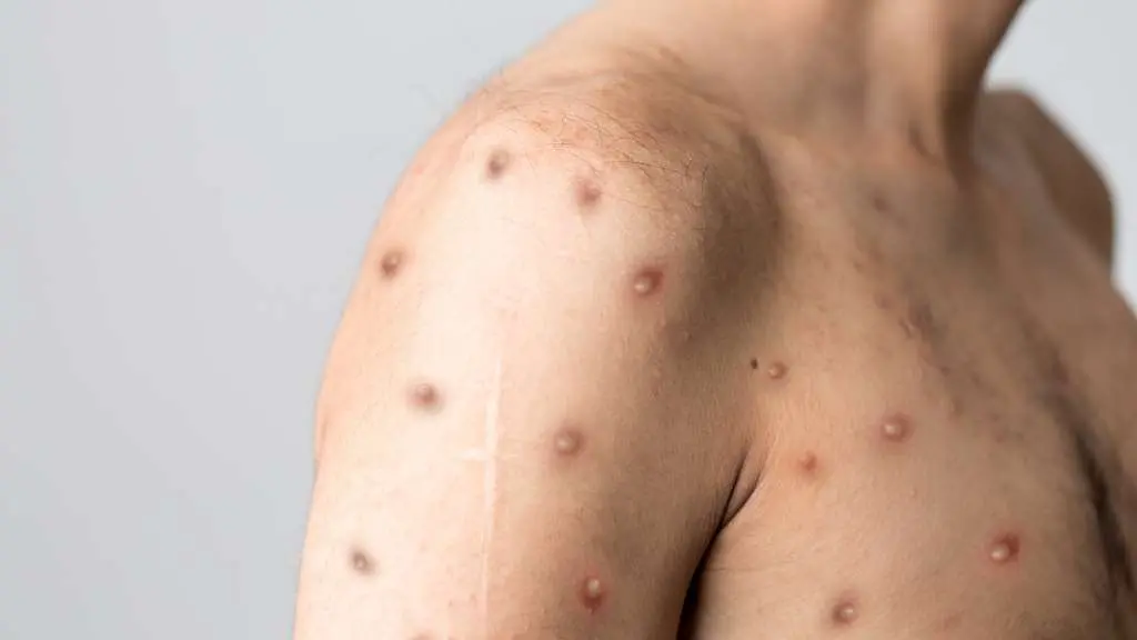 A OMS insta a illar e rastrexar os contactos estreitos dos casos positivos de var&iacute;ola do mono para deter a transmisi&oacute;n. (Foto: Berkay)