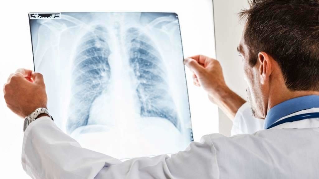 O cancro de pulmón é o cuarto máis frecuente na Galiza. (Foto: Nós Diario)