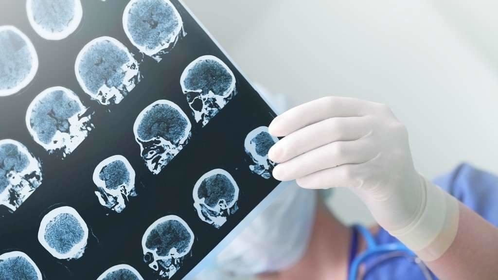 #saúde #mente #mental #epilepsia #cerebro #radiografía Aínda hoxe, en demasiados casos, o diagnóstico baséase no relato de testemuñas das crises, afirman desde a SEN. (Foto: Nós Diario)