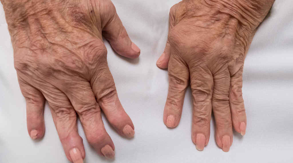 Unha persoa con artrite (Foto: IMSKE).