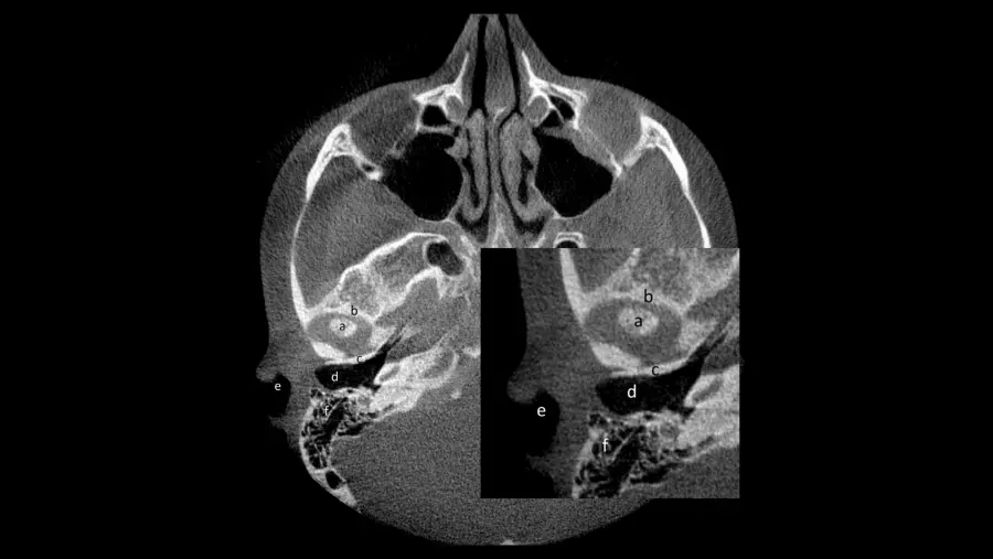 Imaxe ilustrativa da rexi&oacute;n de interese (ROI, polas siglas en ingl&eacute;s) nun corte axial de tomograf&iacute;a computerizada de feixe c&oacute;nico (CBCT). (Foto: USC)