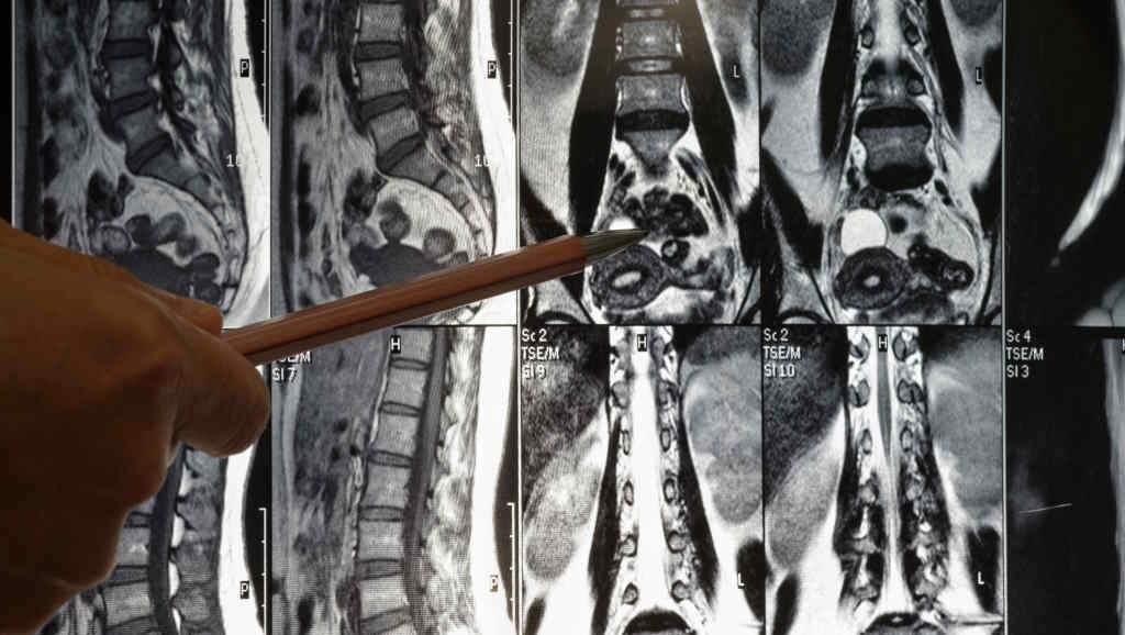 Raios X de lesións medulares (Foto: feelartfeelant / Adobe Stock).