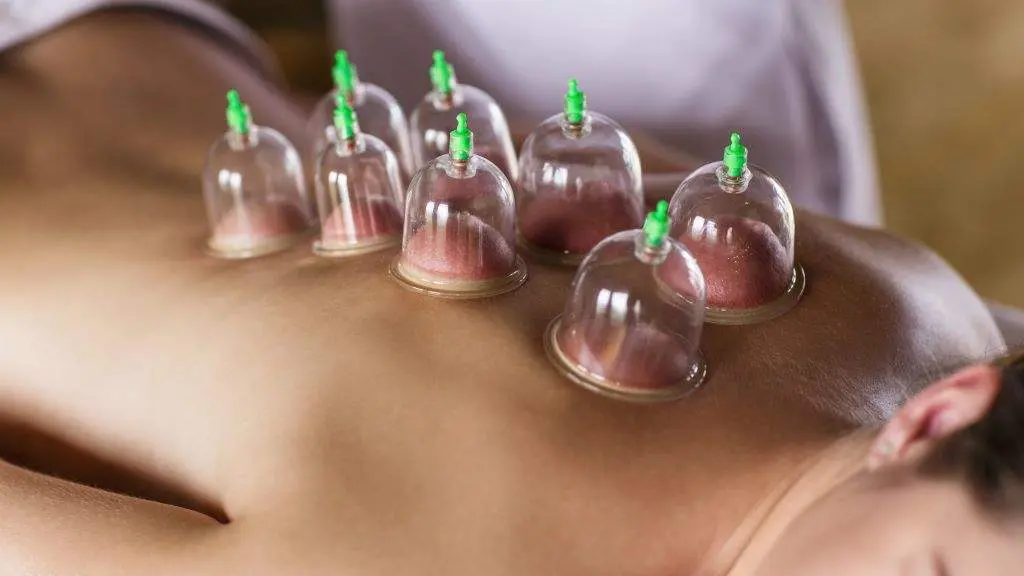 Terapia con ventosas, co&ntilde;ecida como 'cupping' ou vacuoterapia. (Foto: Dmitrii Kotin)