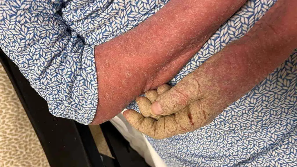 Detalle de como a sarna afecta unha das mans da nai da denunciante. (Foto: N&oacute;s Diario).