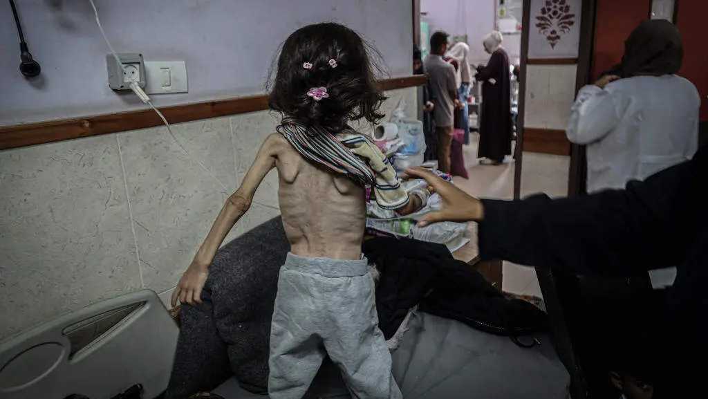 Nena desnutrida en Gaza polas limitaci&oacute;ns israel&iacute;s ao acceso de alimentos. (Saher Alghorra / ZUMA Press Wire / d  / DPA v&iacute;a Europa Press)
