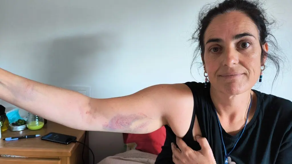 Rosana Prieto, esta segunda feira 8 de setembro, mostrando as lesi&oacute;ns derivadas da intervenci&oacute;n policial do domingo en Monforte. (Foto: N&oacute;s Diario)
