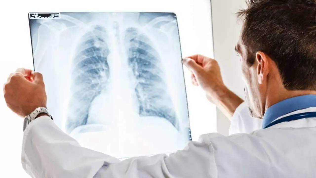 O cancro de pulm&oacute;n &eacute; o cuarto m&aacute;is frecuente na Galiza. (Foto: N&oacute;s Diario)
