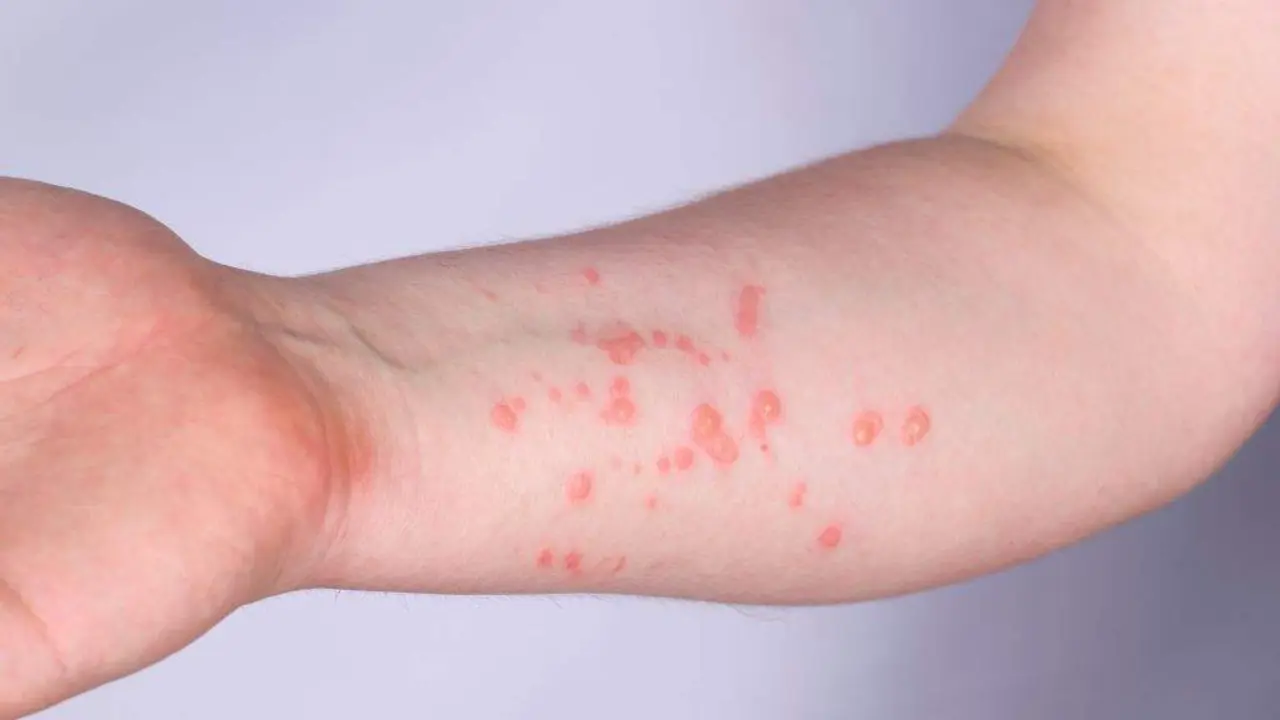 Brazo dunha persoa infectada coa var&iacute;ola do mono. (Foto: N&oacute;s Diario)