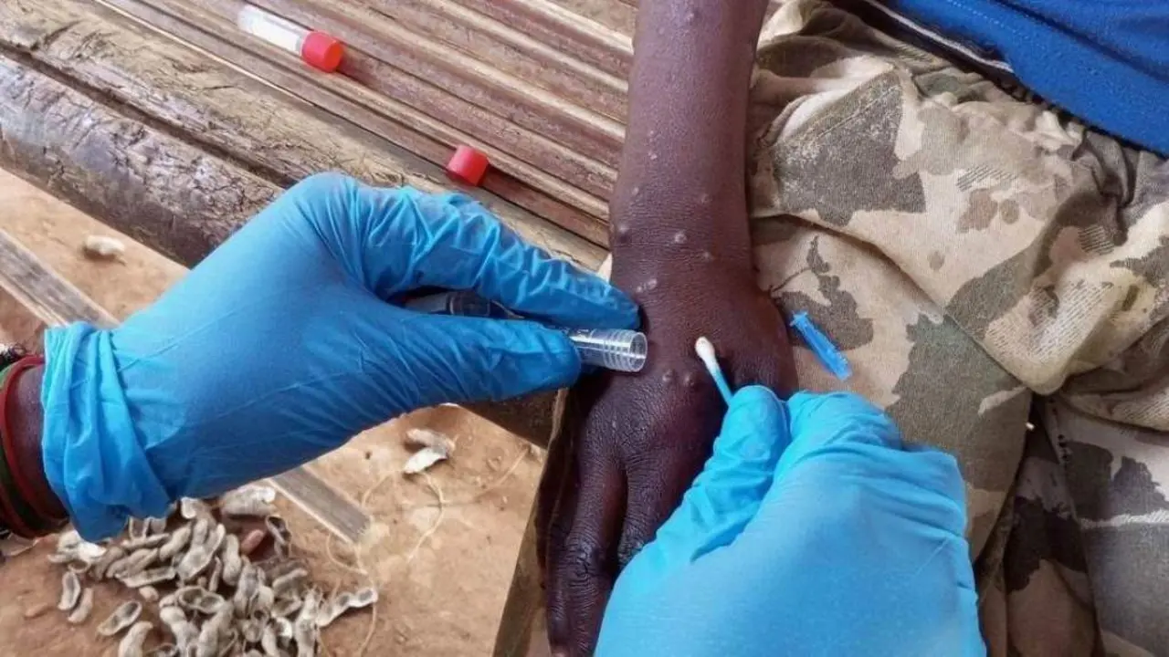 Un sanitario tomando unha mostra dunha persoa infectada con mpox. (Foto: Katson Maliro / OMS)