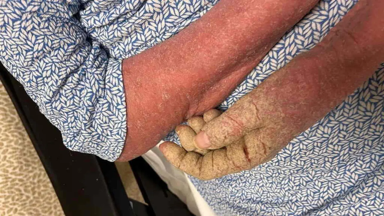 Detalle de como a sarna afecta unha das mans da nai da denunciante. (Foto: N&oacute;s Diario).